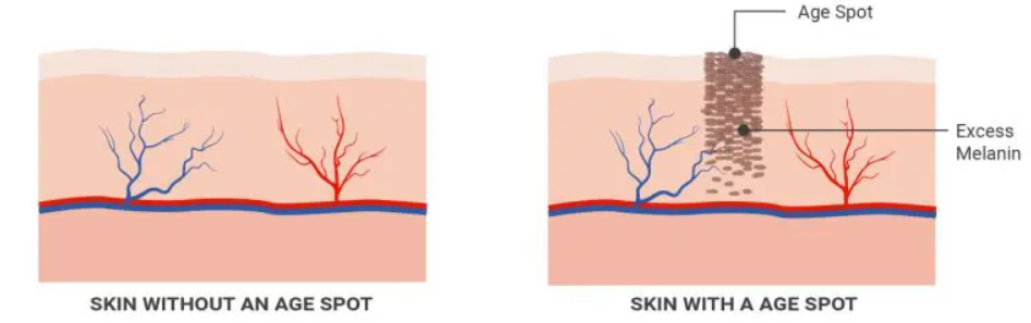 diagram showing skin with and without age spots